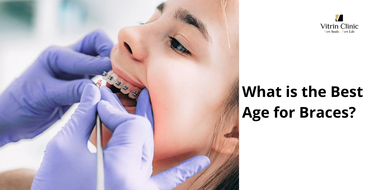 Diş Telleri İçin En İyi Yaş: Kapsamlı Bir Rehber